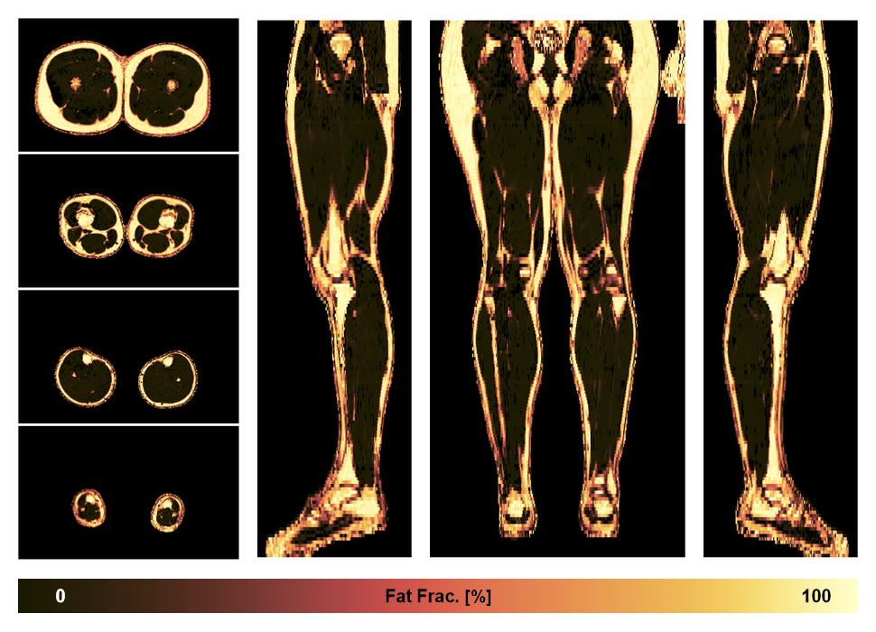 The fat fraction of the lower extremity obtained from the dixon reconstruction for muscle water fat quantification.